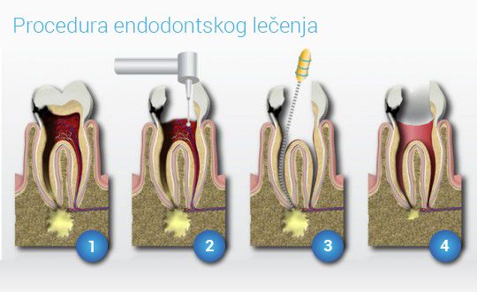 Endodontsko lečenje zuba